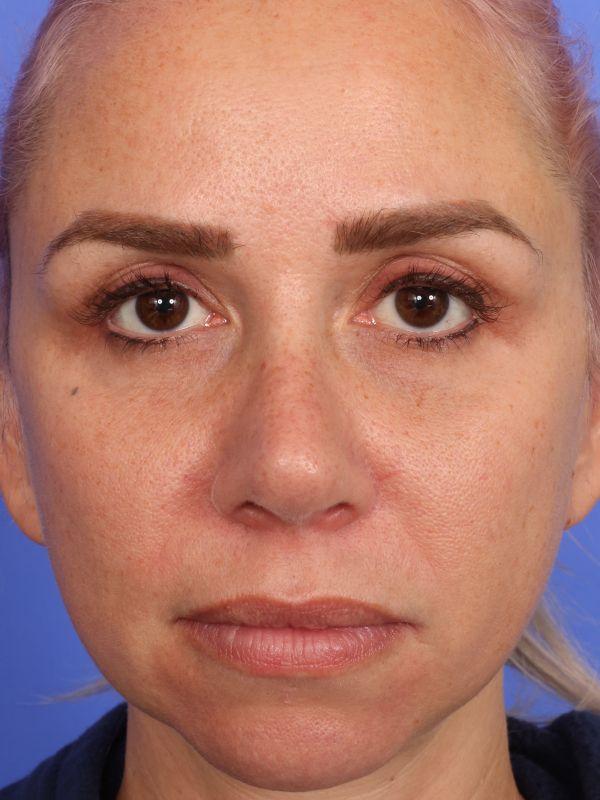 Dr. M.J. Trovato rhinoplasty after — Dallas, TX