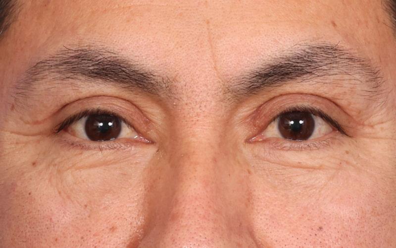 Dr. M.J. Trovato blepharoplasty after — Dallas, TX