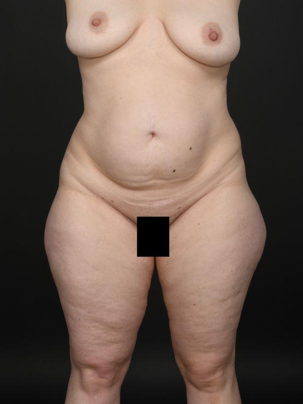 Mommy Makeover before at Dr. M.J. Trovato in Dallas, TX