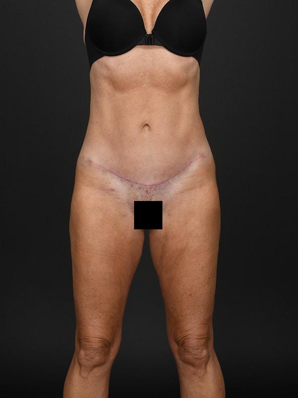 Dr. M.J. Trovato tummy tuck after — Dallas, TX