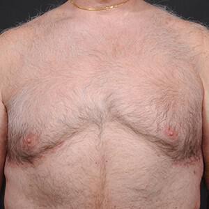 Gynecomastia Surgery after at Dr. M.J. Trovato in Dallas, TX