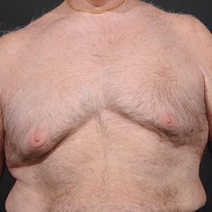 Gynecomastia Surgery before at Dr. M.J. Trovato in Dallas, TX