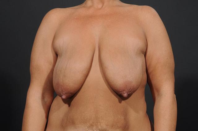Breast Lift before at Dr. M.J. Trovato in Dallas, TX