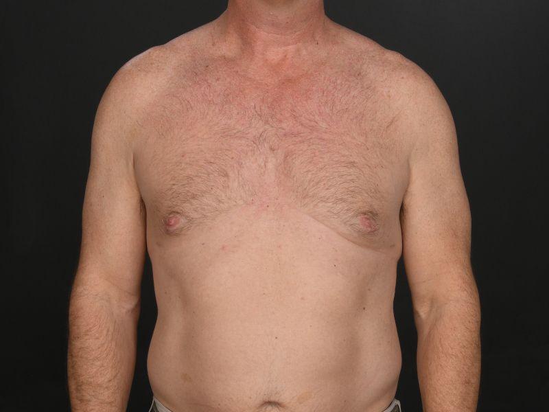 Dr. M.J. Trovato gynecomastia after — Dallas, TX
