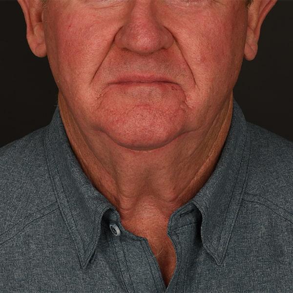 Neck Lift before at Dr. M.J. Trovato in Dallas, TX