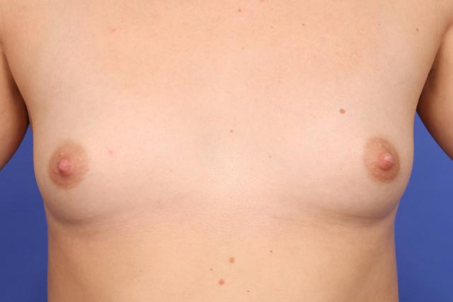 Fat Transfer Breast Augmentation before at Dr. M.J. Trovato in Dallas, TX