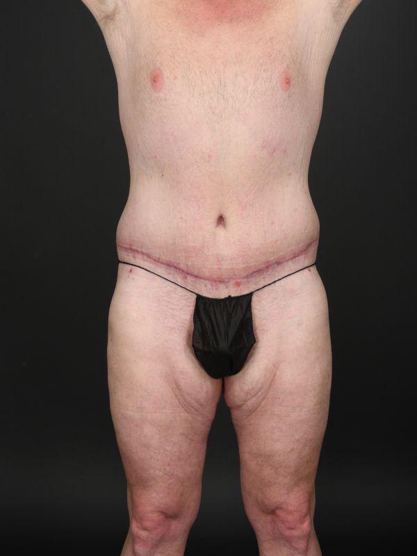 Dr. M.J. Trovato tummy tuck after — Dallas, TX