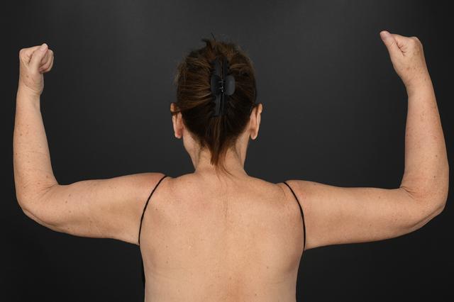 Arm Lift after at Dr. M.J. Trovato in Dallas, TX