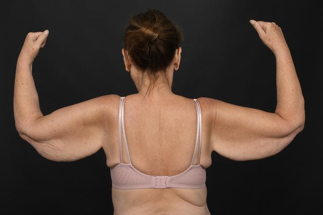 Arm Lift before at Dr. M.J. Trovato in Dallas, TX