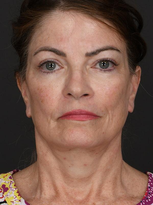 Dr. M.J. Trovato facelift after — Dallas, TX