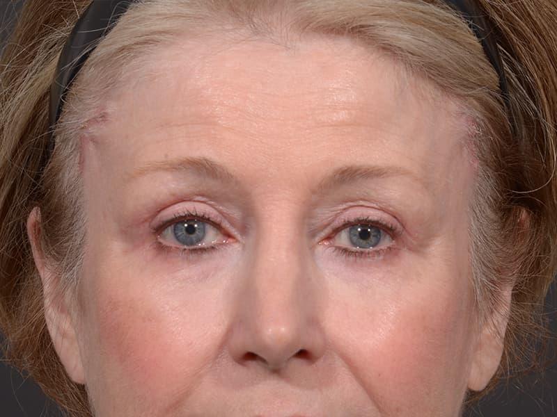 Dr. M.J. Trovato blepharoplasty after — Dallas, TX