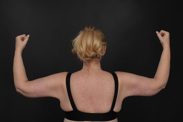 Arm Lift after at Dr. M.J. Trovato in Dallas, TX