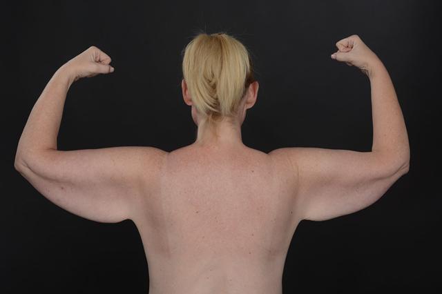 Arm Lift before at Dr. M.J. Trovato in Dallas, TX