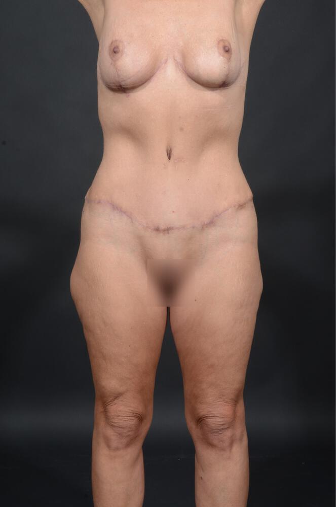 Dr. M.J. Trovato mommy makeover after — Dallas, TX