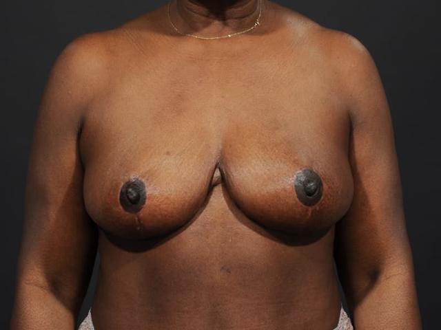 Breast Reduction after at Dr. M.J. Trovato in Dallas, TX