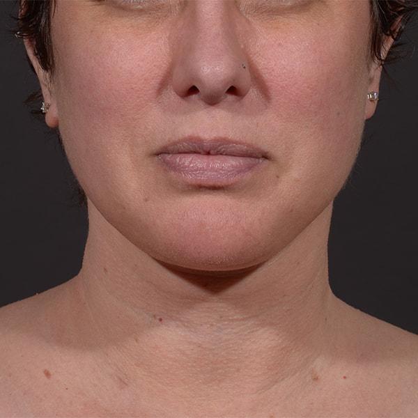 Neck Lift after at Dr. M.J. Trovato in Dallas, TX