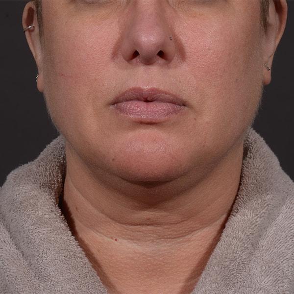 Neck Lift before at Dr. M.J. Trovato in Dallas, TX