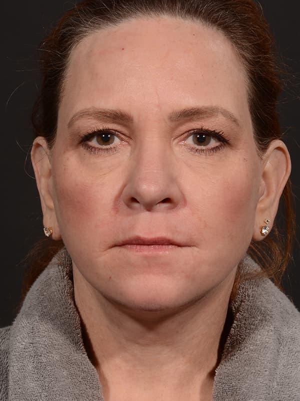 Dr. M.J. Trovato facelift after — Dallas, TX
