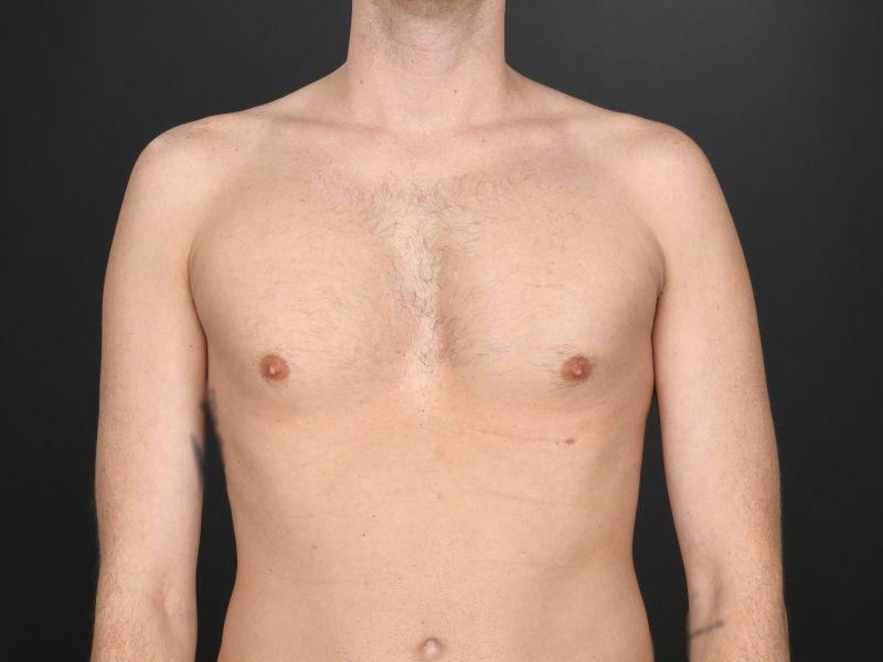 Dr. M.J. Trovato body contouring after — Dallas, TX