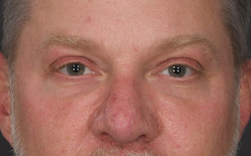 Dr. M.J. Trovato blepharoplasty after — Dallas, TX