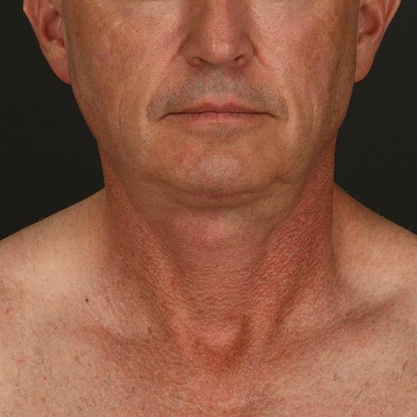 Neck Lift after at Dr. M.J. Trovato in Dallas, TX