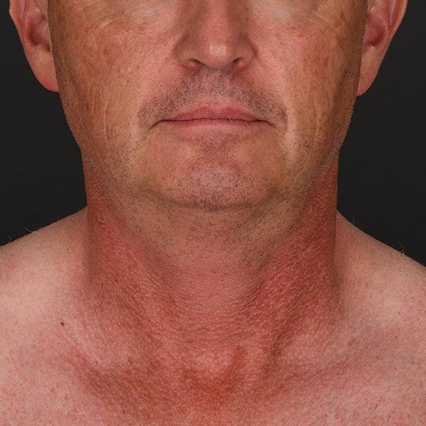 Neck Lift before at Dr. M.J. Trovato in Dallas, TX