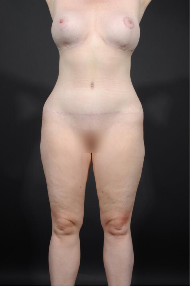 Dr. M.J. Trovato mommy makeover after — Dallas, TX