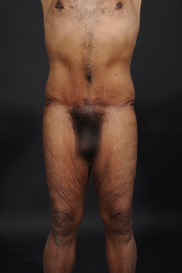 Tummy Tuck after at Dr. M.J. Trovato in Dallas, TX