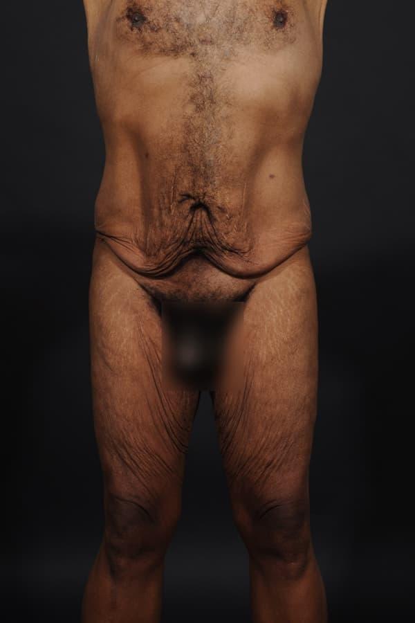 Tummy Tuck before at Dr. M.J. Trovato in Dallas, TX