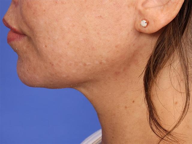 Neck Liposuction after at Dr. M.J. Trovato in Dallas, TX