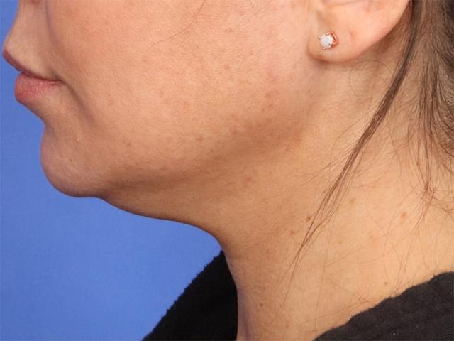 Neck Liposuction before at Dr. M.J. Trovato in Dallas, TX