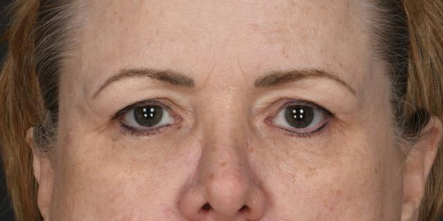 Brow Lift before at Dr. M.J. Trovato in Dallas, TX