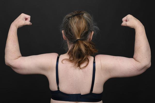 Arm Lift after at Dr. M.J. Trovato in Dallas, TX