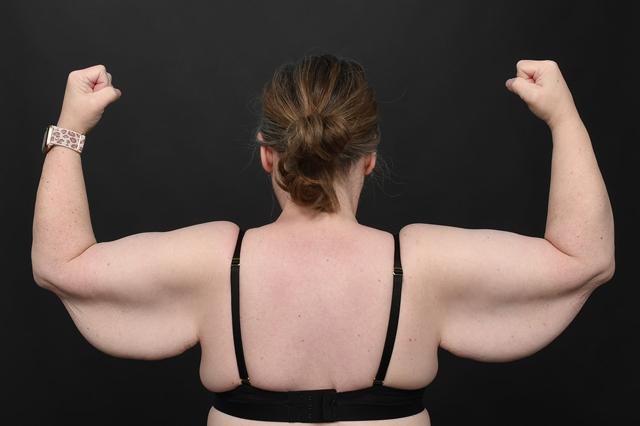 Arm Lift before at Dr. M.J. Trovato in Dallas, TX