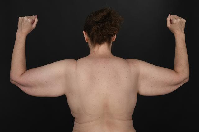 Arm Lift before at Dr. M.J. Trovato in Dallas, TX