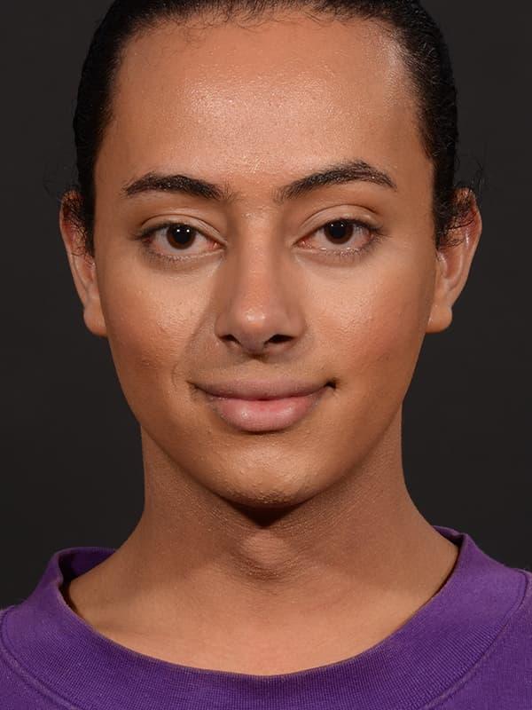 Liquid Rhinoplasty after at Dr. M.J. Trovato in Dallas, TX