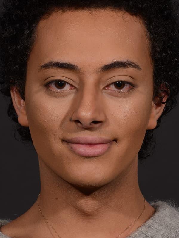 Liquid Rhinoplasty before at Dr. M.J. Trovato in Dallas, TX