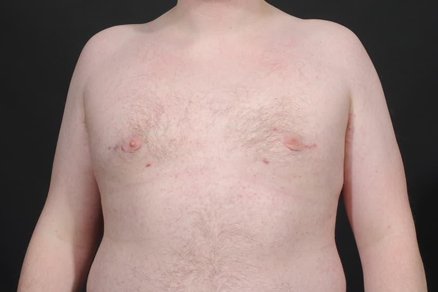 Dr. M.J. Trovato gynecomastia after — Dallas, TX