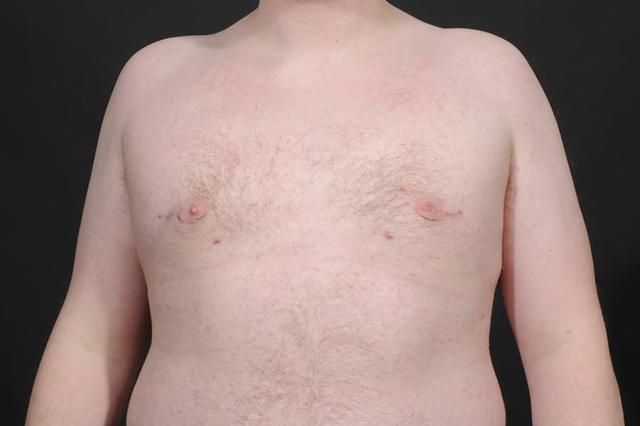 Gynecomastia Surgery after at Dr. M.J. Trovato in Dallas, TX