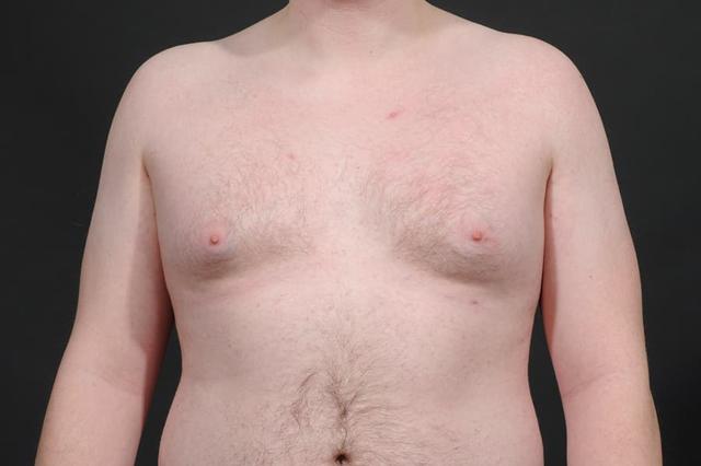 Gynecomastia Surgery before at Dr. M.J. Trovato in Dallas, TX