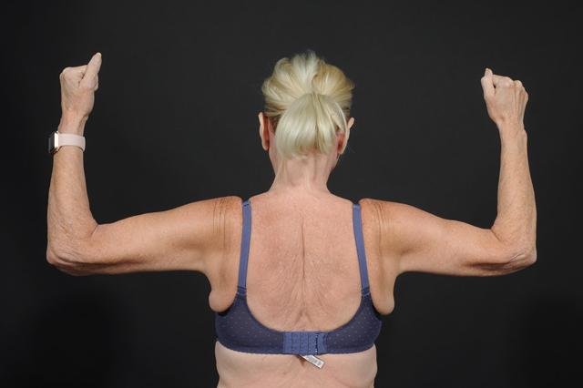 Arm Lift after at Dr. M.J. Trovato in Dallas, TX