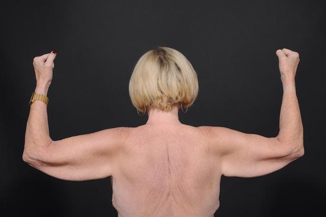 Arm Lift before at Dr. M.J. Trovato in Dallas, TX