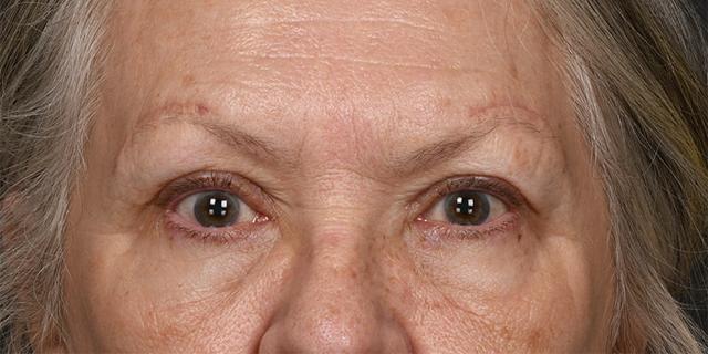 Brow Lift after at Dr. M.J. Trovato in Dallas, TX