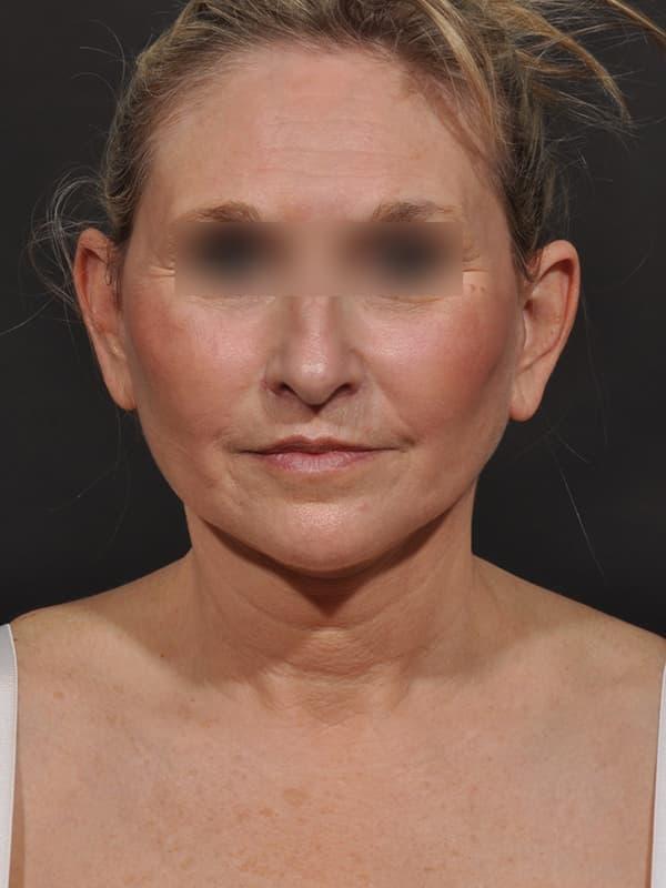 Dr. M.J. Trovato facelift after — Dallas, TX