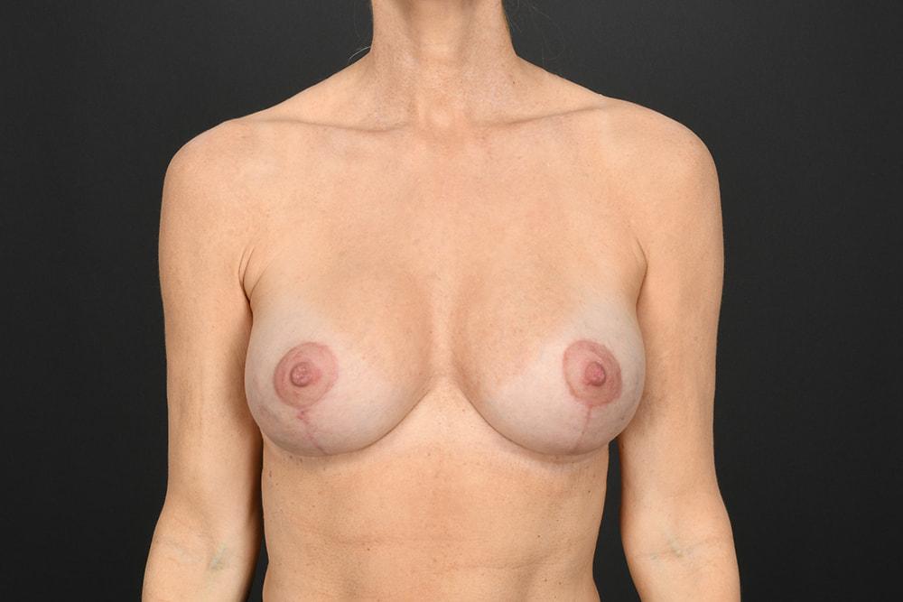 Dr. M.J. Trovato breast augmentation after — Dallas, TX