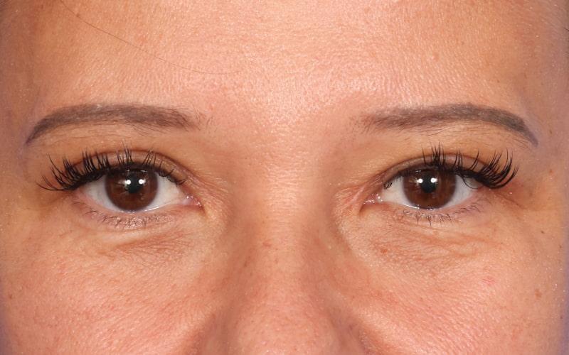 Dr. M.J. Trovato blepharoplasty after — Dallas, TX