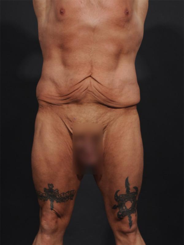 Tummy Tuck before at Dr. M.J. Trovato in Dallas, TX