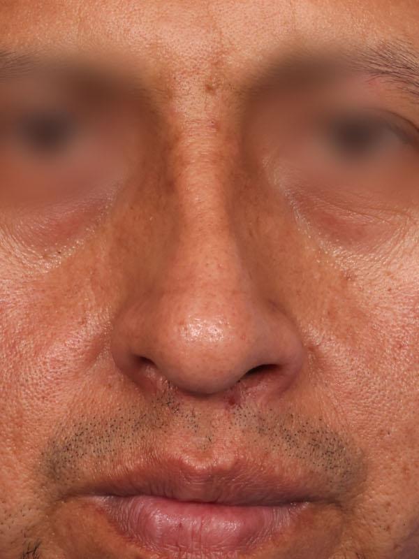 Dr. M.J. Trovato rhinoplasty after — Dallas, TX