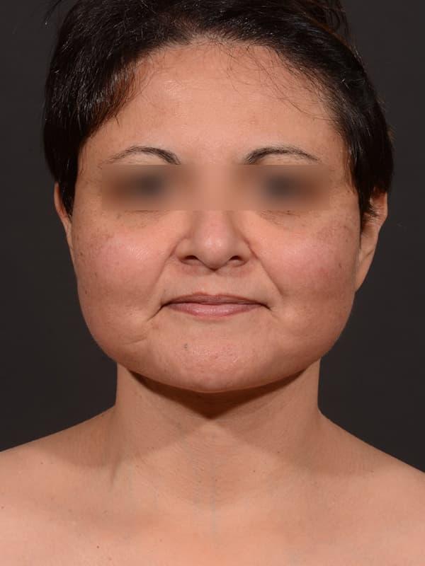Dr. M.J. Trovato facelift after — Dallas, TX