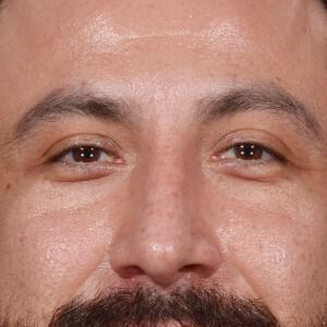 Liquid Rhinoplasty after at Dr. M.J. Trovato in Dallas, TX